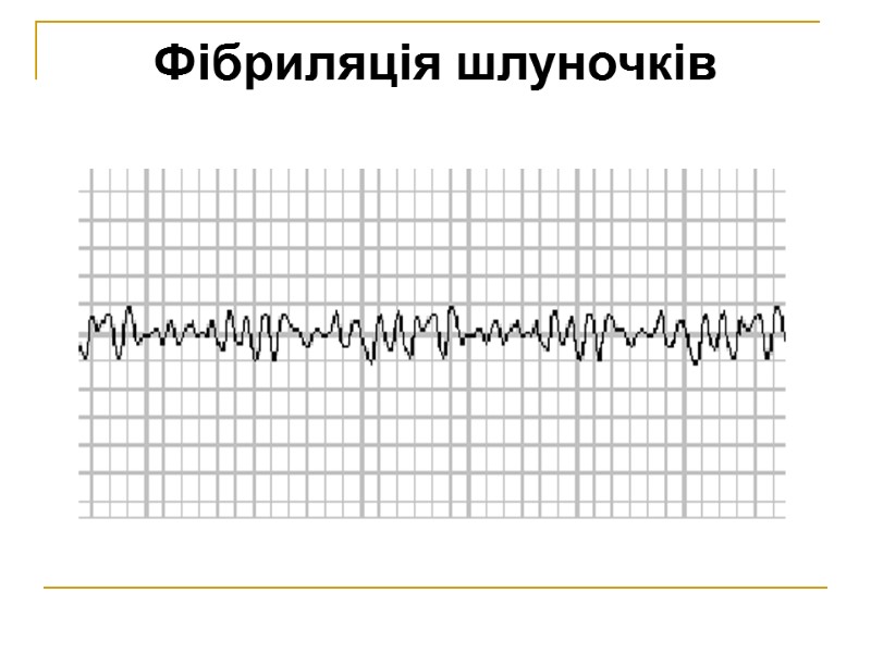 Фібриляція шлуночків